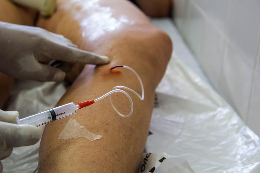 pandemia fez cirurgias de varizes pelo sus despencarem 69 no pais