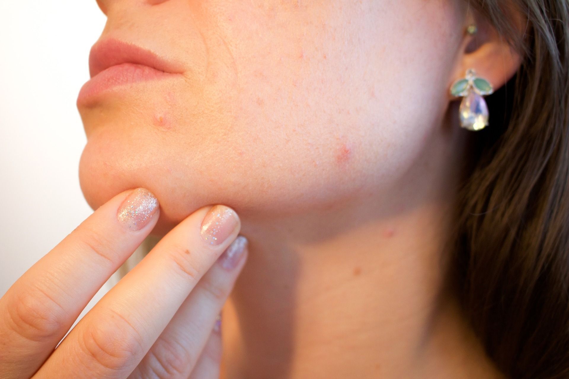 Como combater a acne?