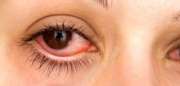 A conjuntivite é uma doença ocular que causa inflamação da conjuntiva e na esclera (parte branca do olho), uma membrana transparente e fina que reveste a parte da frente do globo ocular e a parte interna das pálpebras.