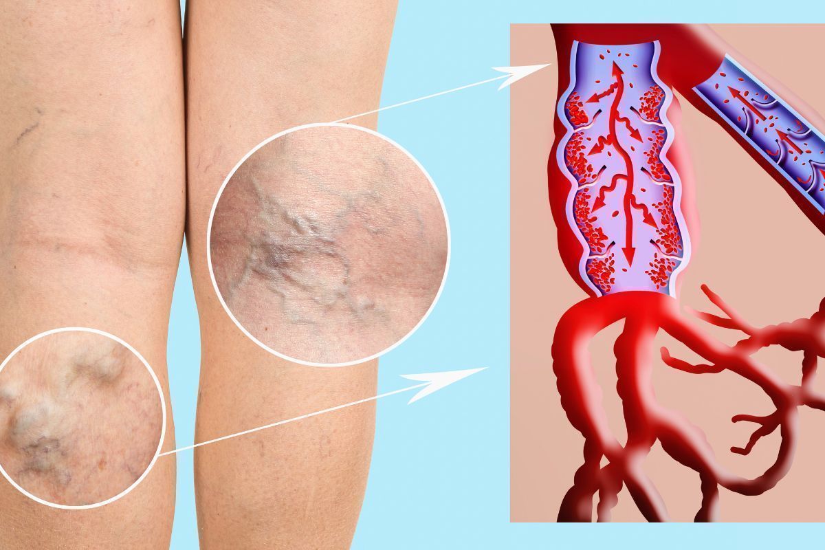 Pomada para varizes e dores nas pernas: mito ou verdade? Confira os detalhes rapidamente