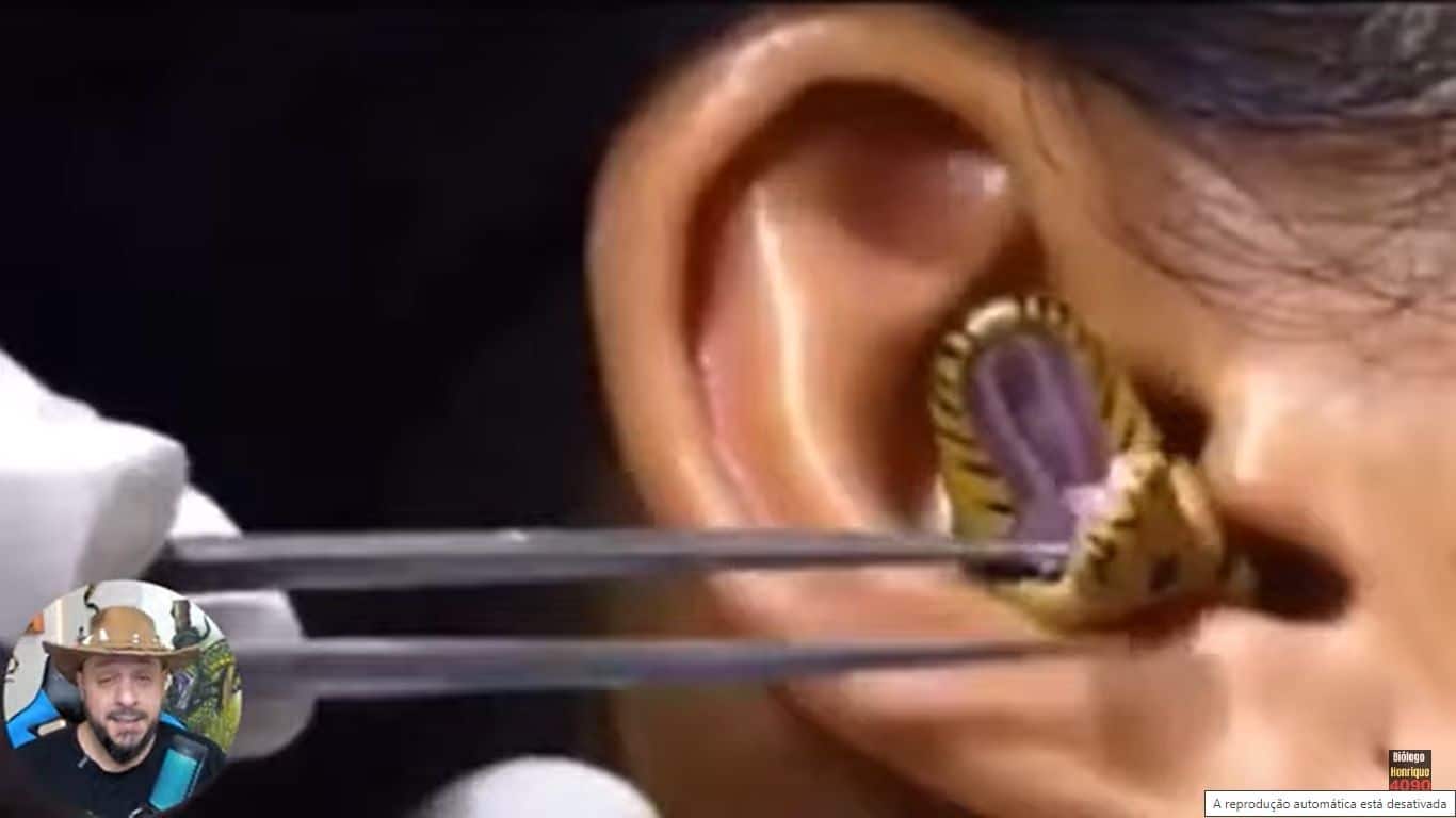 Um vídeo que está circulando nas redes mostra o momento em que um profissional da saúde tenta tirar a cobra do canal auditivo da mulher, usando duas pinças