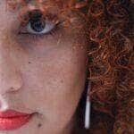 Como controlar o melasma?