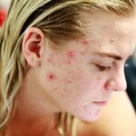 Você sabia que existem diferentes tipos de acne?