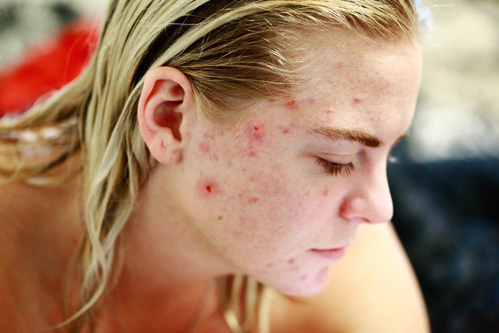 Você sabia que existem diferentes tipos de acne?