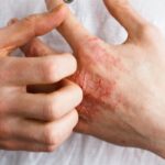 Pode causar erupções cutâneas: Quais são os riscos de ter fungos de pele?