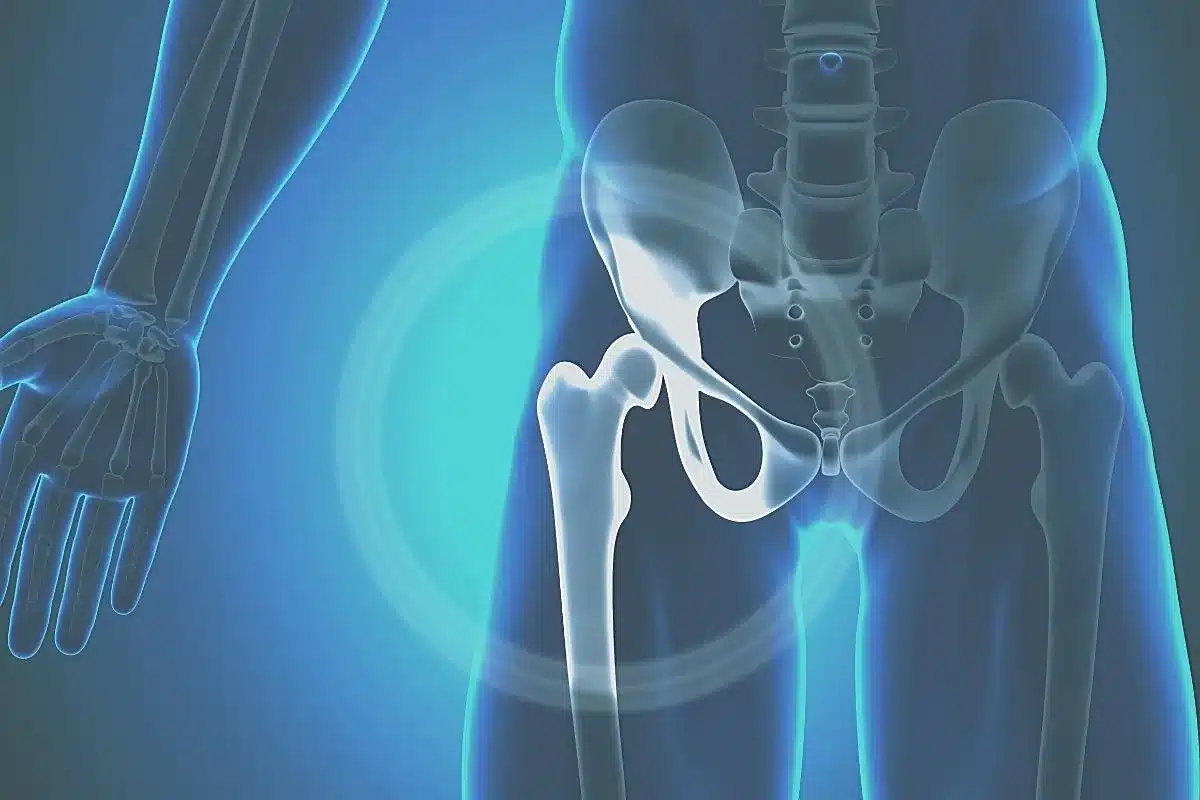 Tudo o que você precisa saber sobre a osteoporose transitória do quadril