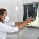 brasil registra 78 mil novos casos de tuberculose em 2022
