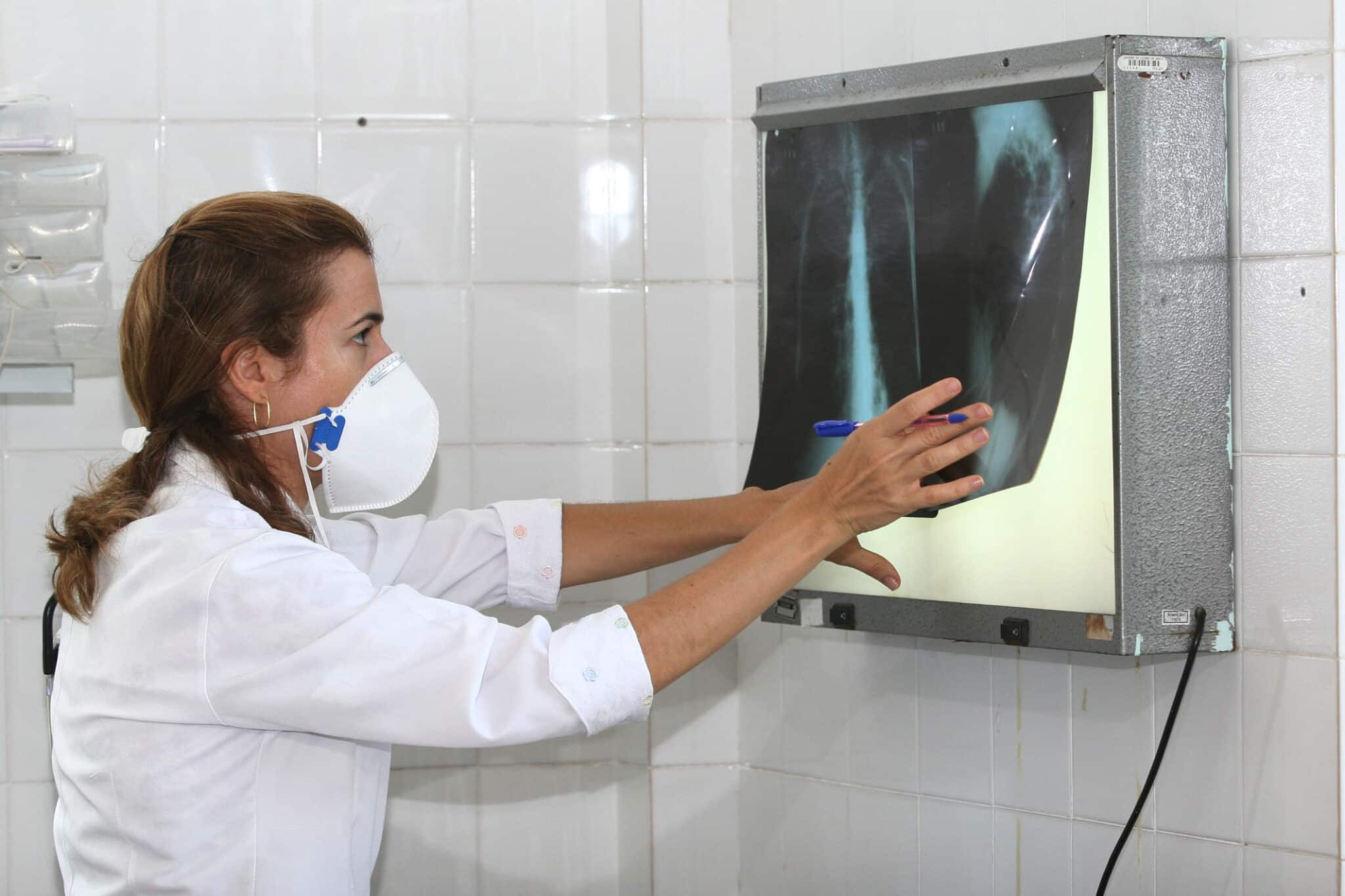 brasil registra 78 mil novos casos de tuberculose em 2022