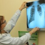 conselho aprova novas diretrizes para tratamento da tuberculose no sus