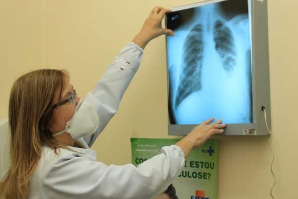 conselho aprova novas diretrizes para tratamento da tuberculose no sus