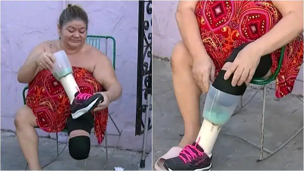 À espera de prótese, mulher com perna amputada improvisa com liquidificador