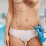 woman marked out cosmetic surgery