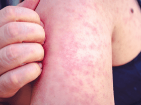 Autoridades de Sorriso alerta sobre baixa cobertura da 2ª dose de vacina de Sarampo