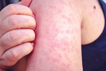 Autoridades de Sorriso alerta sobre baixa cobertura da 2ª dose de vacina de Sarampo