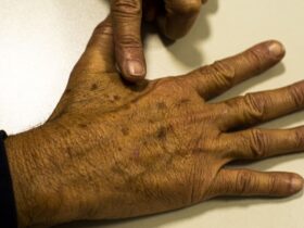 câncer de pele, melanoma Foto: Marcello Casal Jr/Agência Brasil/Arquivo