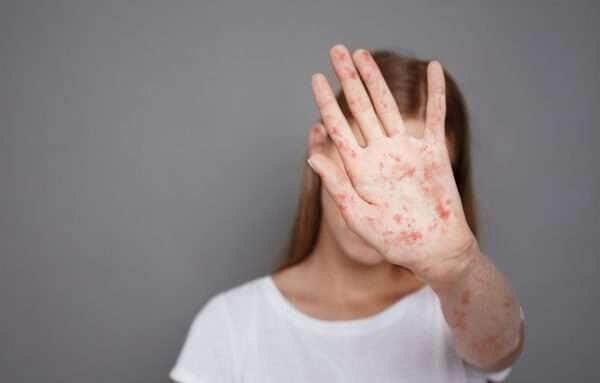 Cuiabá emite alerta de sarampo por risco de surto em países vizinhos e baixa vacinação