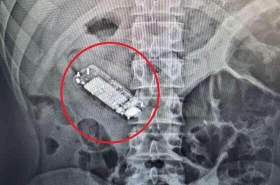 Raio-X revelou que aparelho engolido obstruía sistema digestivo do preso; Sejus-MT investiga falha na segurança