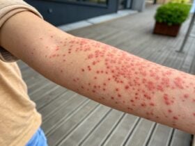 Sexto caso de sarampo é confirmado em Primavera do Leste